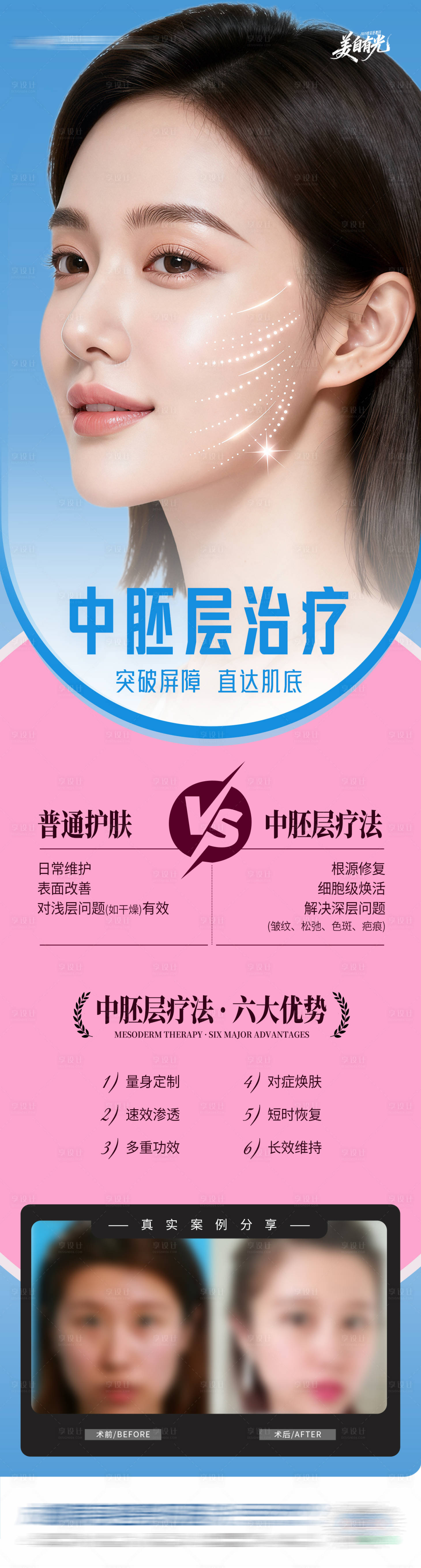 源文件下载【享设计】搜索编号：18010034332824082【医美皮肤中胚层治疗创意案例长图海报】