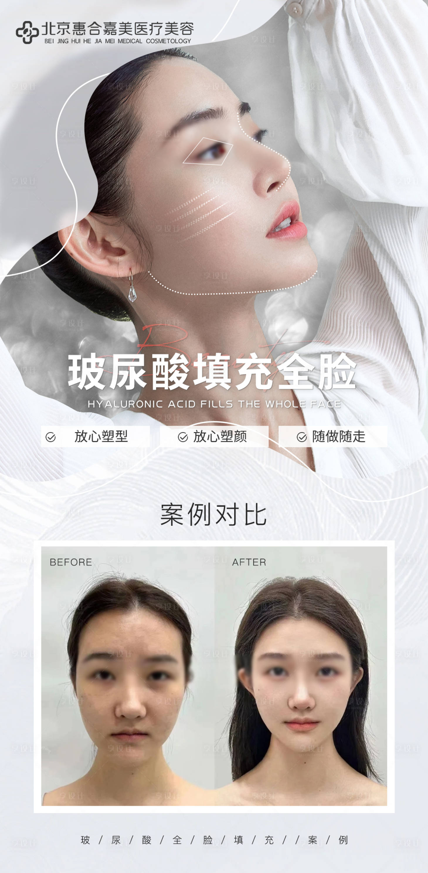 源文件下载【享设计】搜索编号：44610034444282151【玻尿酸案例对比海报】