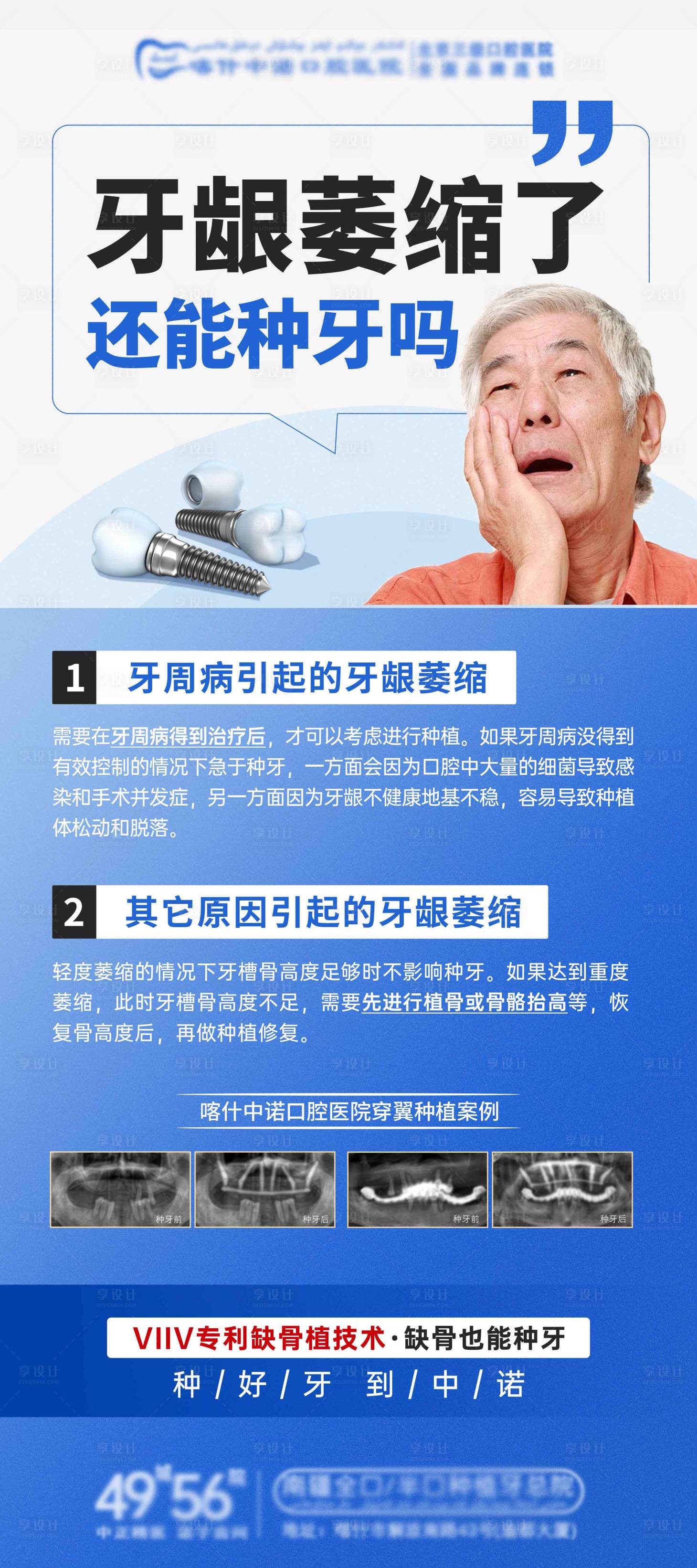 源文件下载【享设计】搜索编号：16520034634935446【牙龈萎缩能种牙展架】