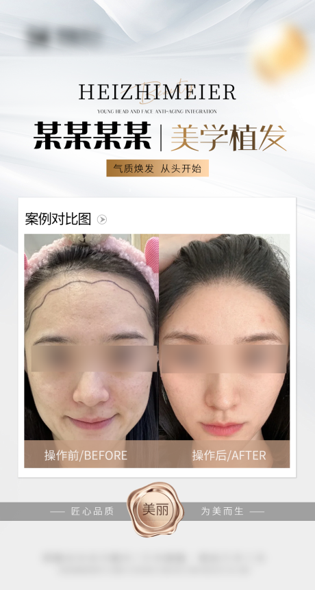 源文件下載【享設計】搜索編號：73240034542164284【醫美頭皮案例海報】