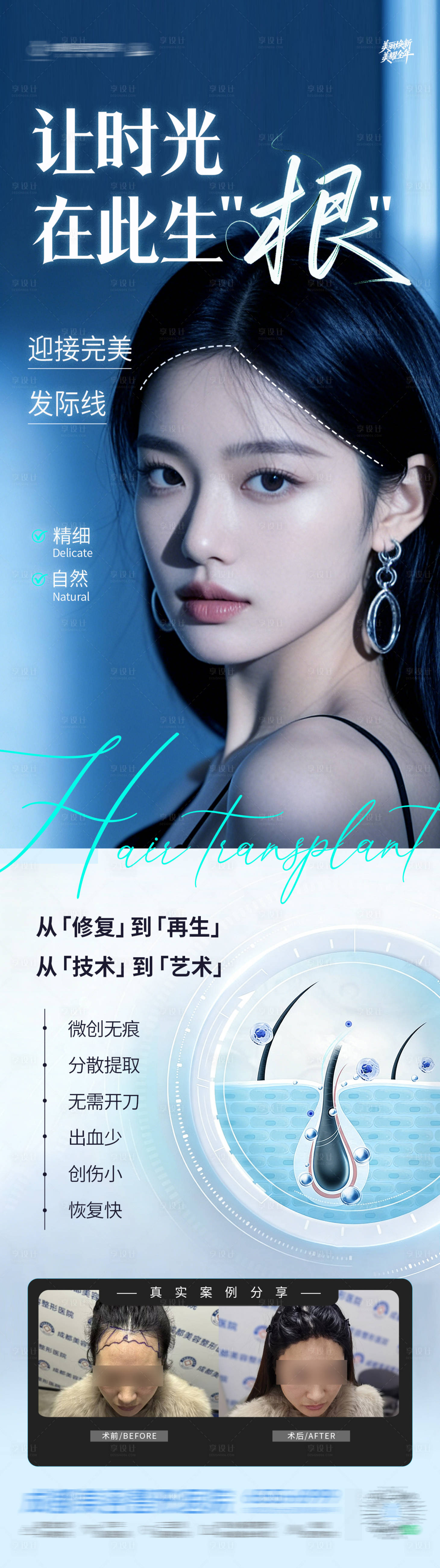 源文件下载【享设计】搜索编号：10790034903982321【发际线地中海植发案例创意海报】