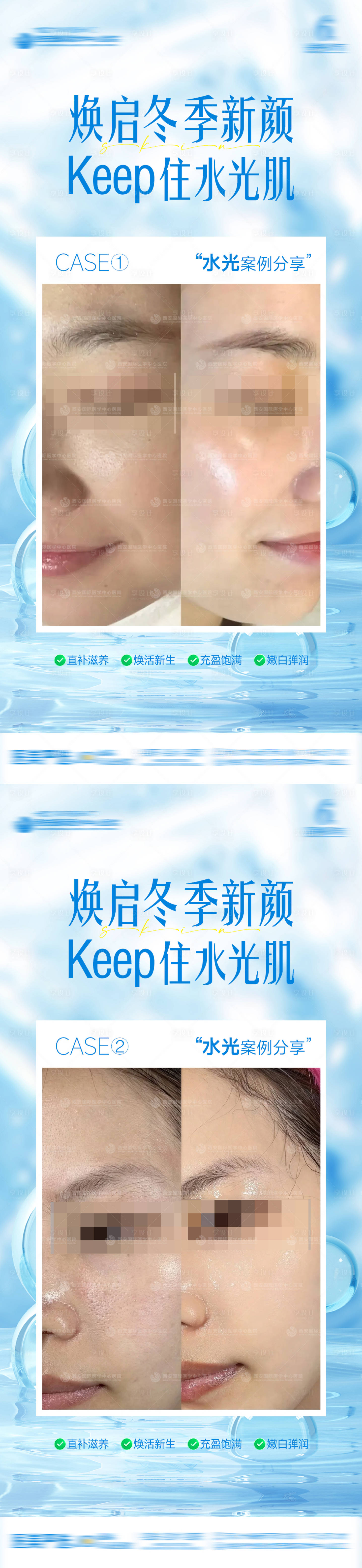 源文件下载【享设计】搜索编号：91790034994758277【医美整形冬季补水水光肌案例对比海报】