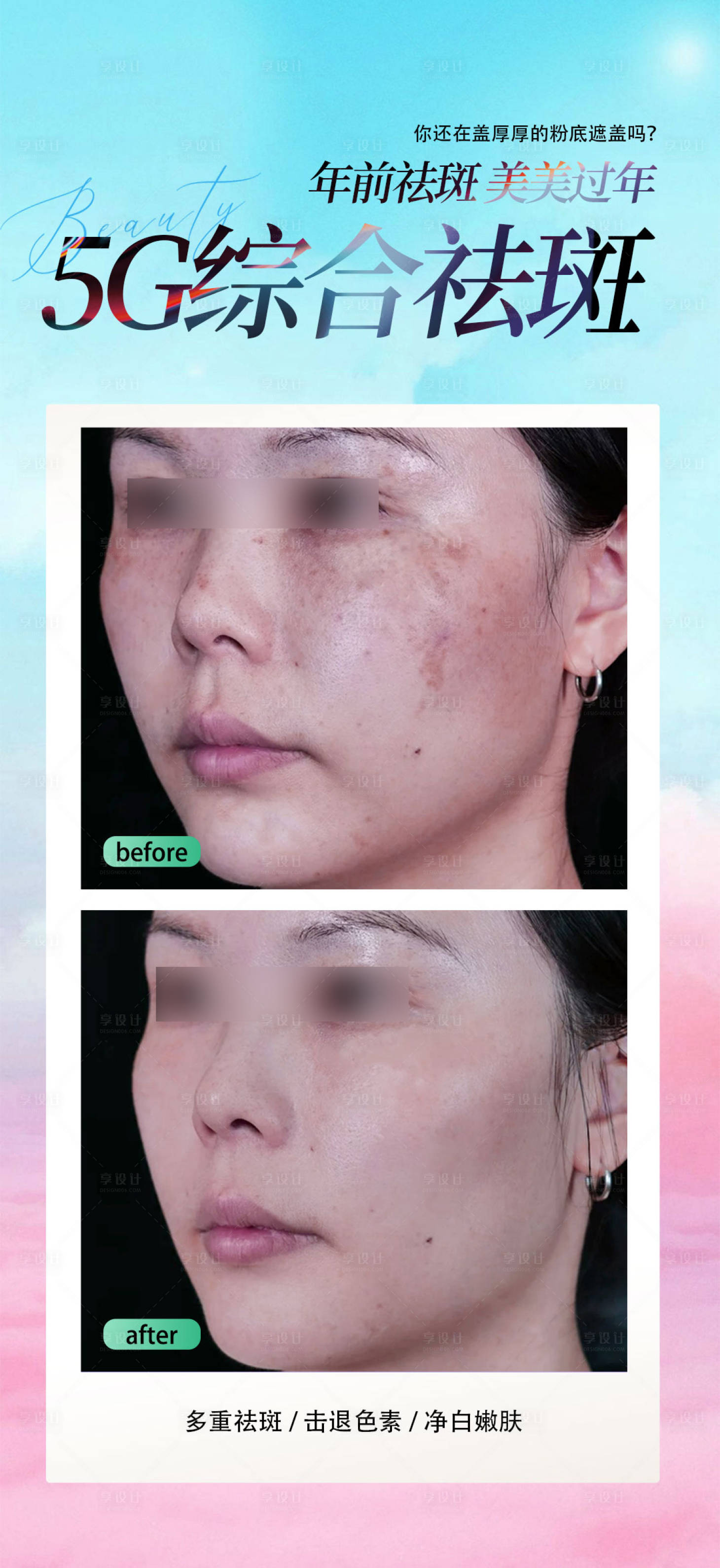 源文件下载【享设计】搜索编号：86690034808103971【5G综合祛斑】
