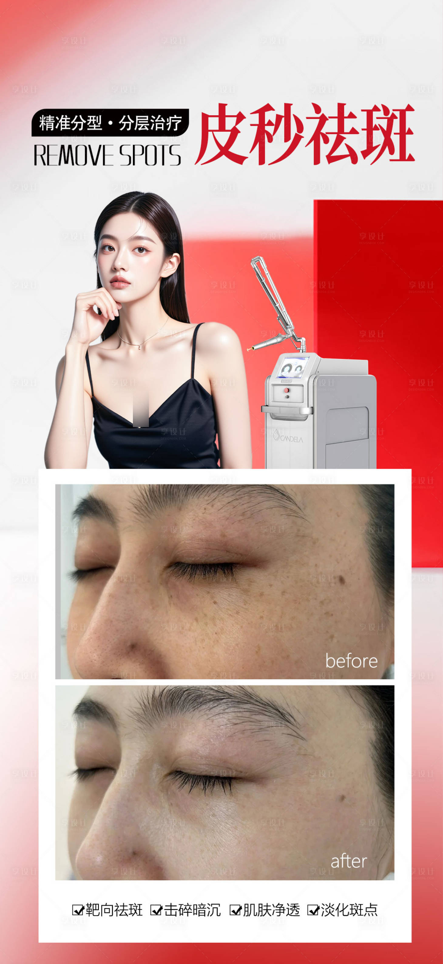 源文件下载【享设计】搜索编号：50060035151166281【皮秒祛斑案例海报】