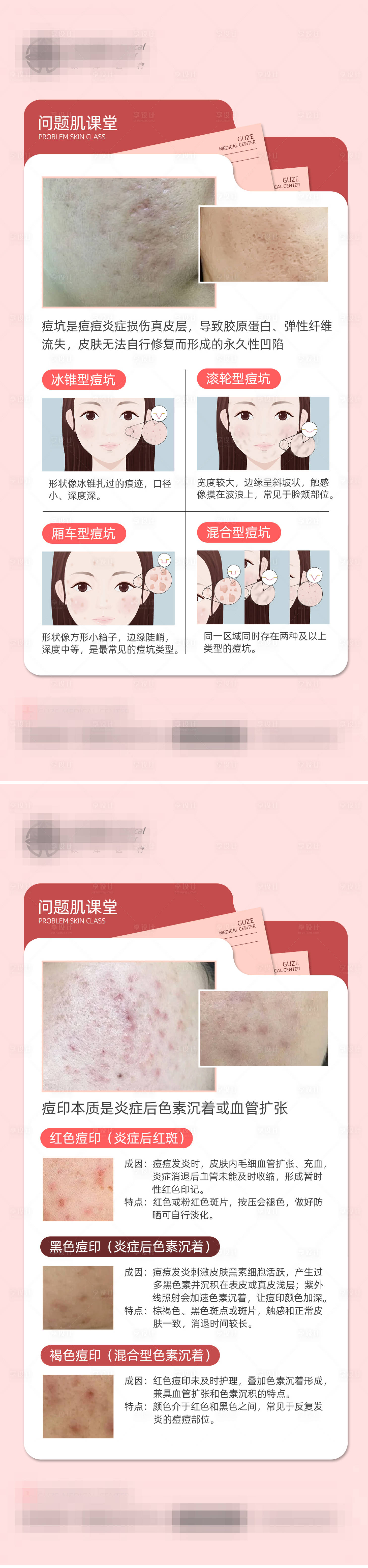 源文件下载【享设计】搜索编号：41660035063933552【痘印痘坑科普系列海报】