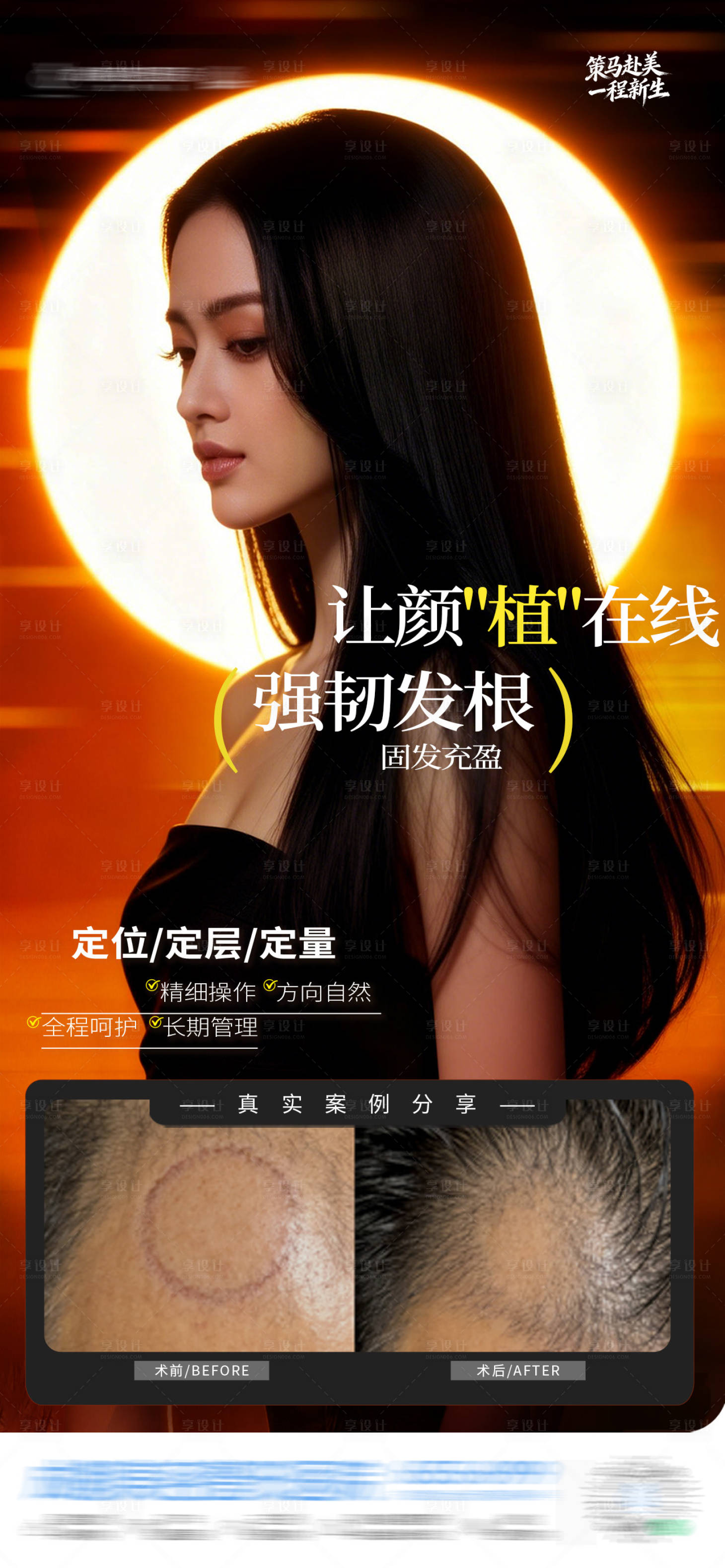 源文件下载【享设计】搜索编号：52060035406023897【医美植发疤痕斑秃发案例海报】