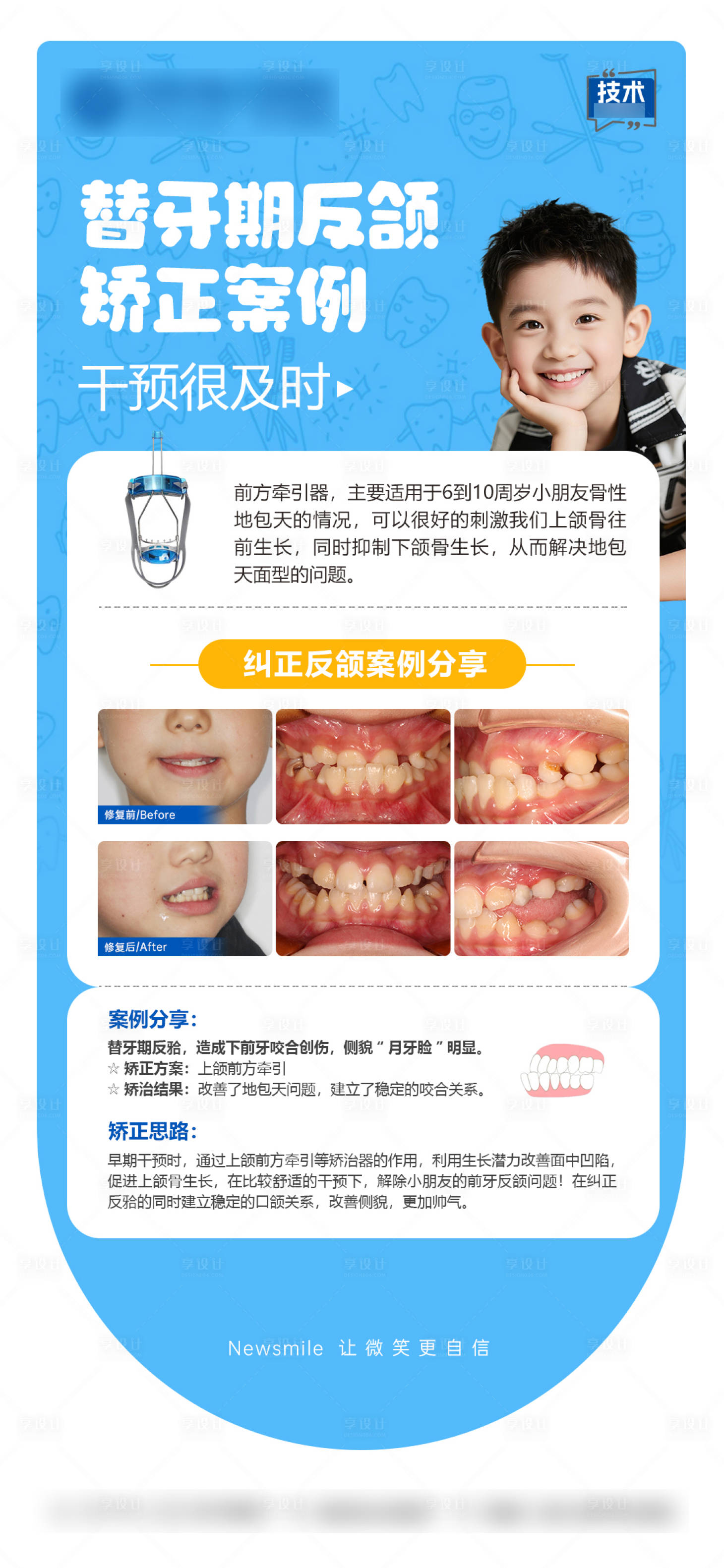源文件下载【享设计】搜索编号：96240035444139119【儿童反颌矫正科普海报】