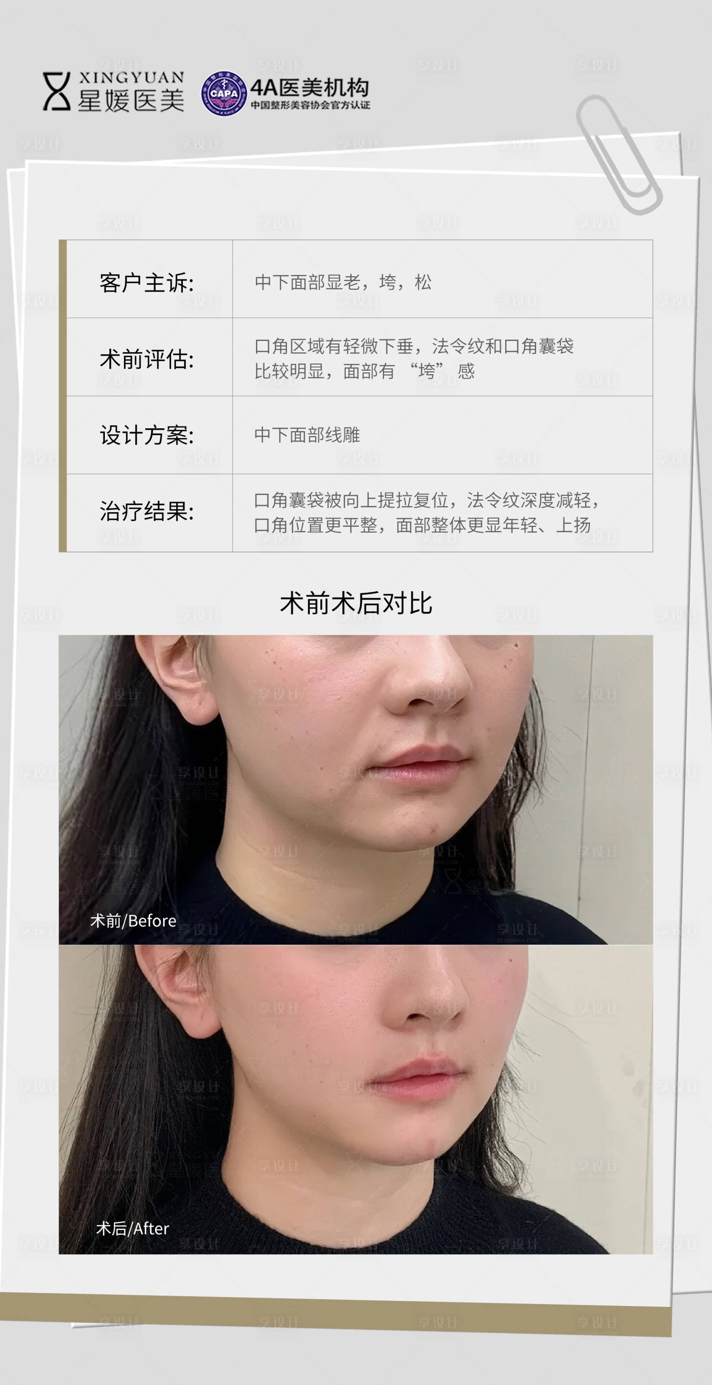 源文件下载【享设计】搜索编号：84860036060444894【医美治疗对比图】