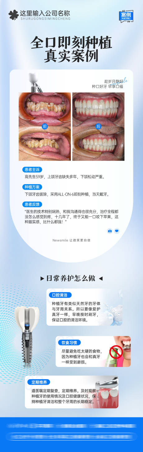 源文件下载【享设计】搜索编号：72110036016675676【全口即刻种植真实案例】