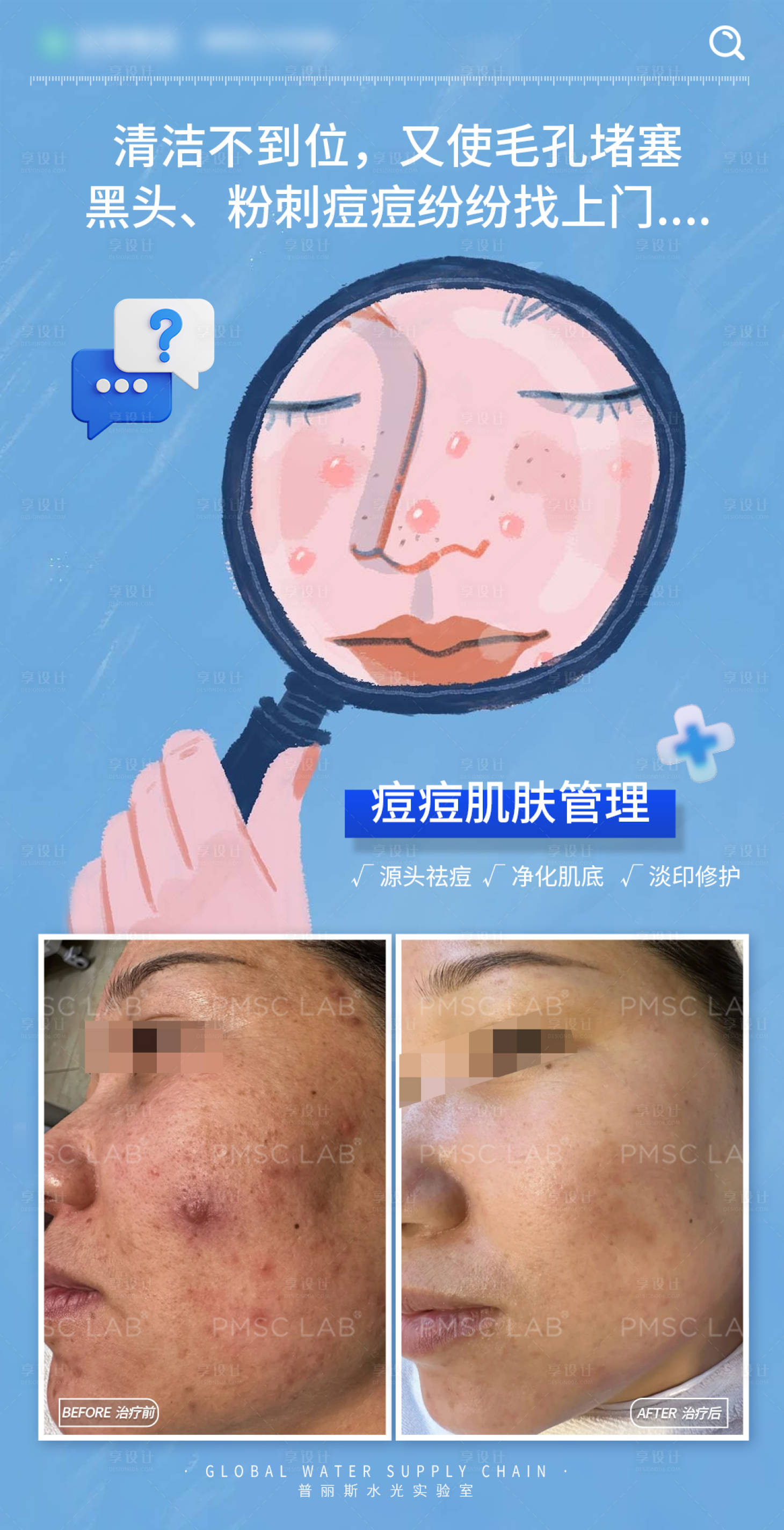 源文件下载【享设计】搜索编号：97460035826864754【痘痘肌肤管理宣传海报】