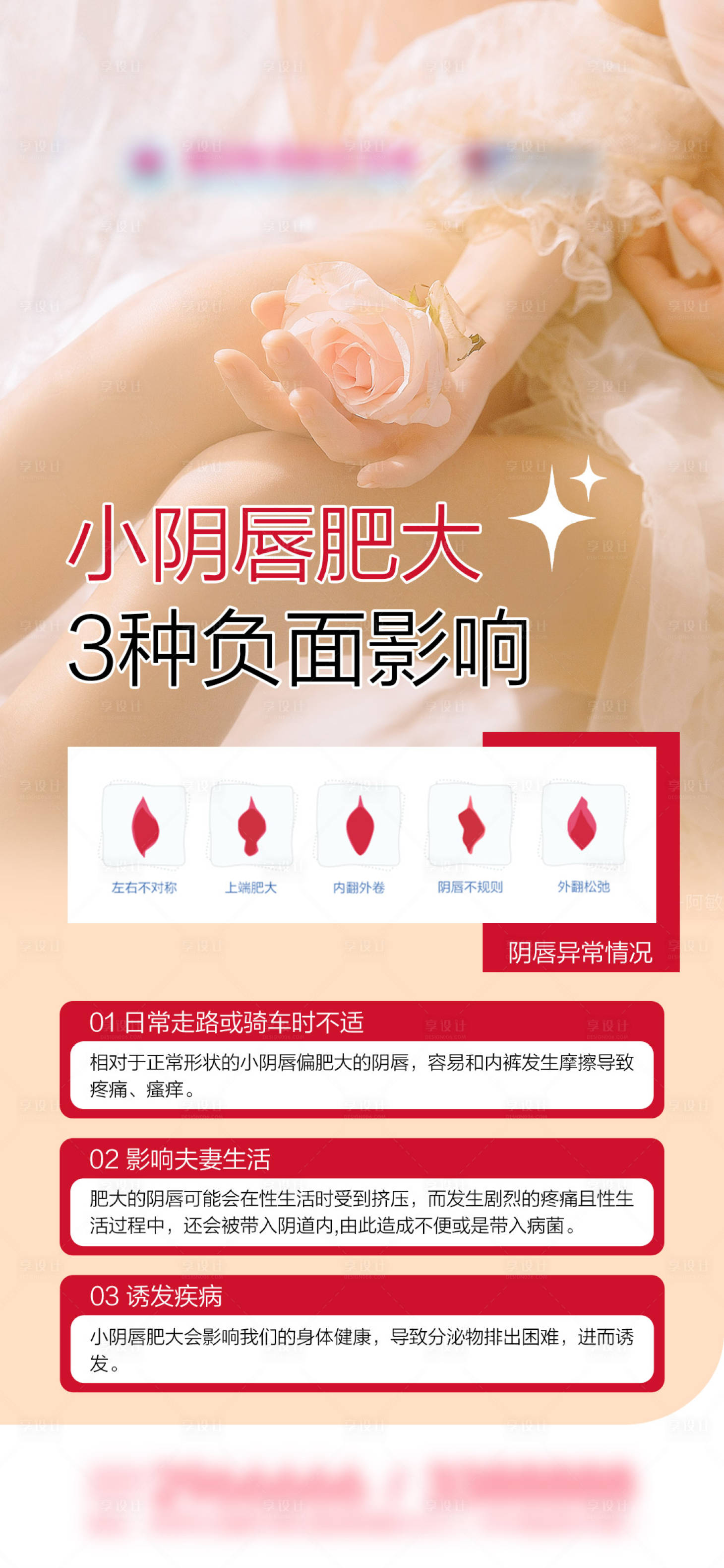 源文件下载【享设计】搜索编号：91930035967941443【小阴唇肥大种负面影响科普海报】