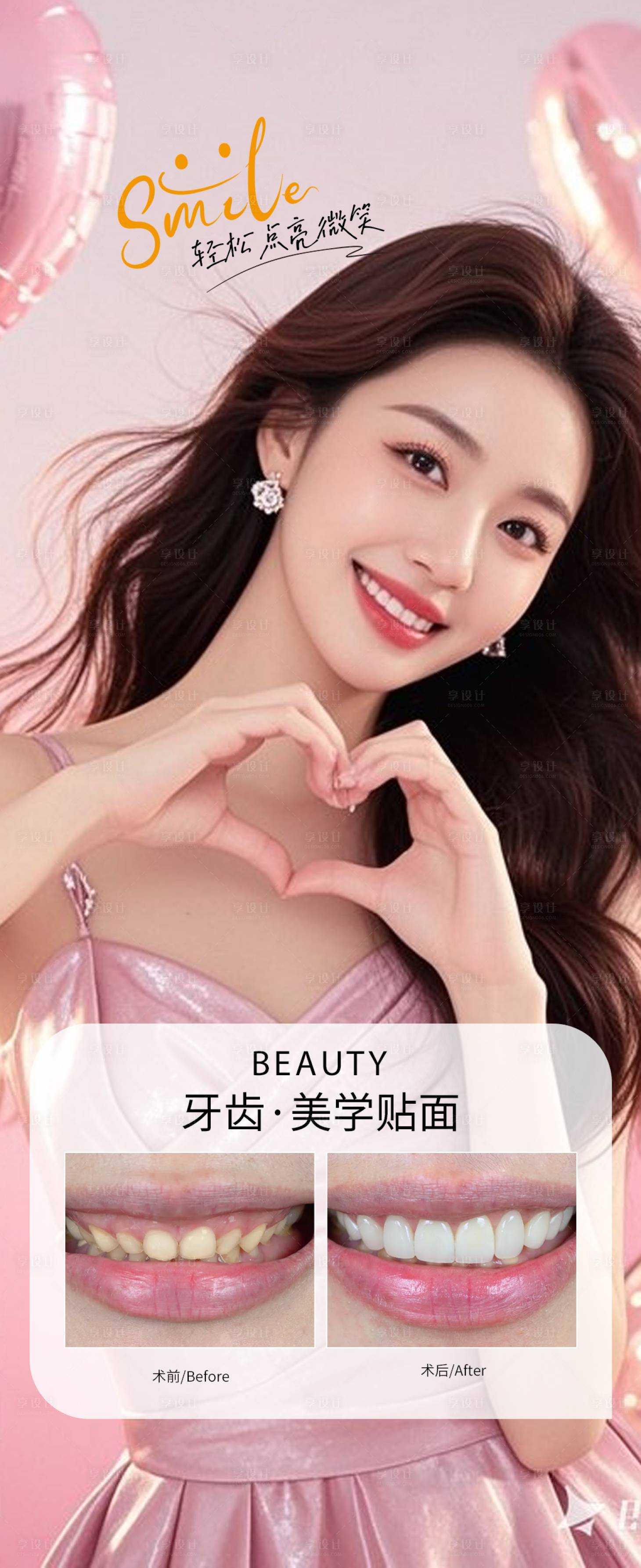 源文件下载【享设计】搜索编号：47190036022365189【牙贴面案例海报】
