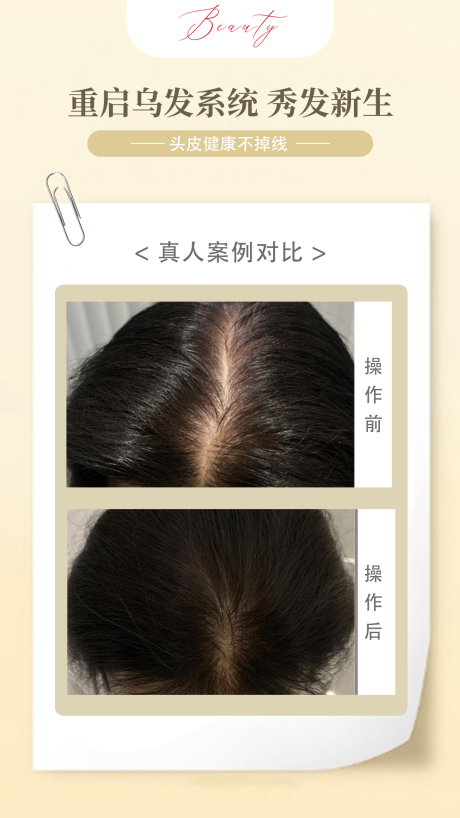 源文件下载【享设计】搜索编号：78440036041962095【头皮抗衰案例海报】