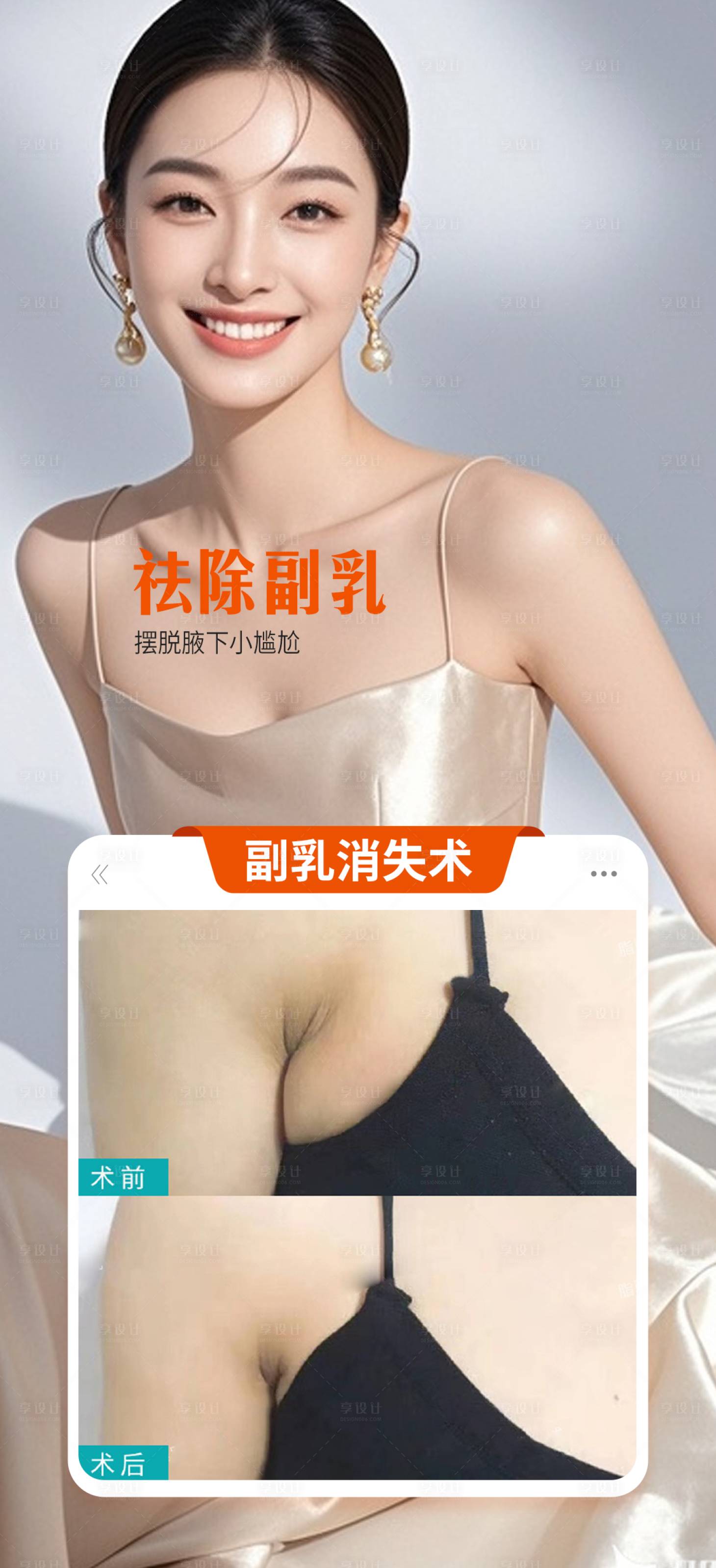 源文件下载【享设计】搜索编号：44390036208653564【副乳消除术海报】