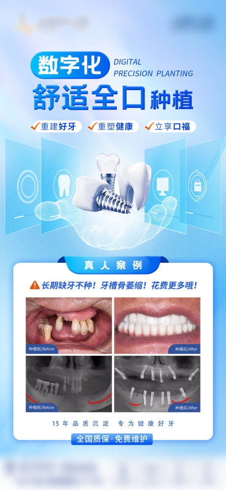 源文件下载【享设计】搜索编号：14530036223478413【种植牙案例】