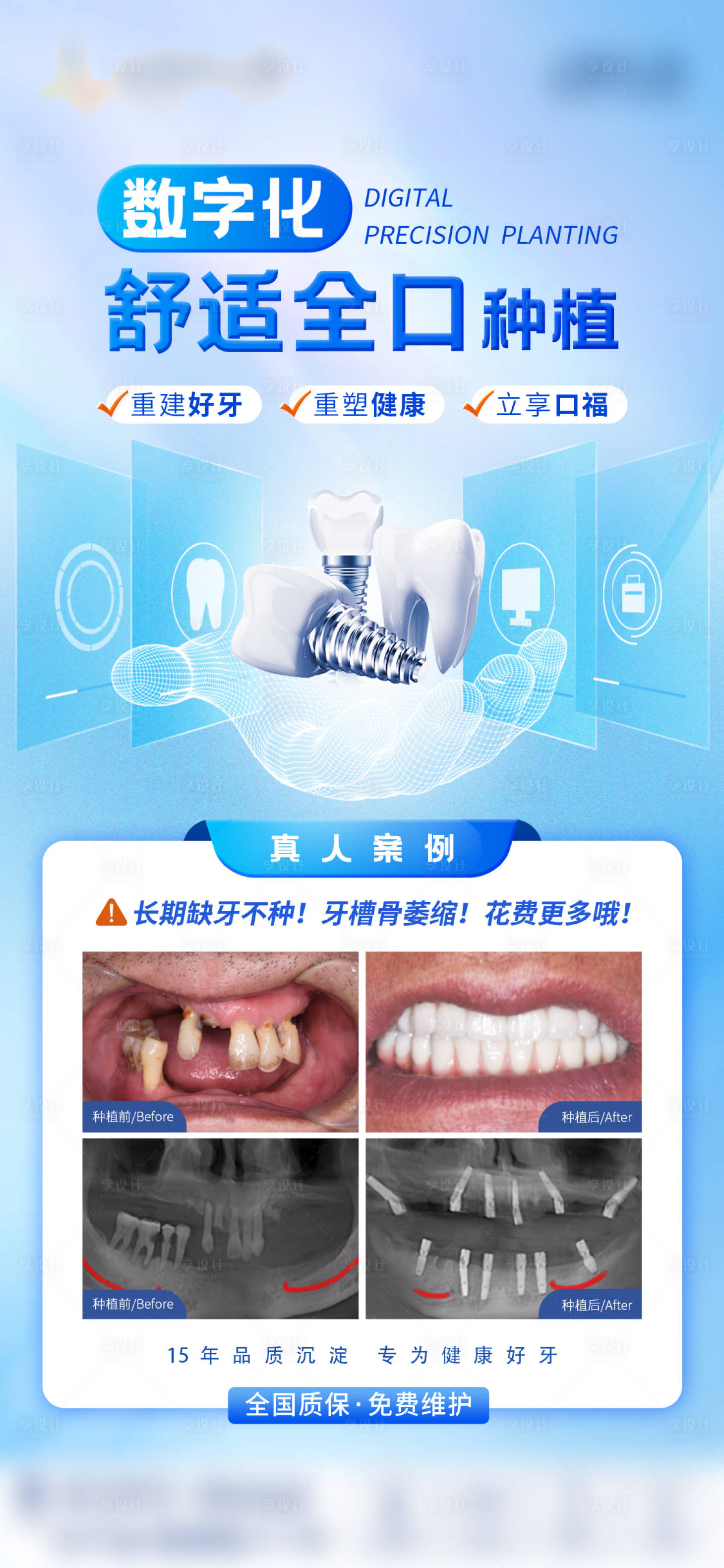 源文件下载【享设计】搜索编号：14530036223478413【种植牙案例】