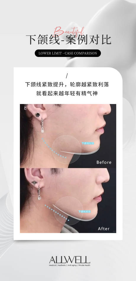 源文件下载【享设计】搜索编号：60870036376218427【下颚线对比图】