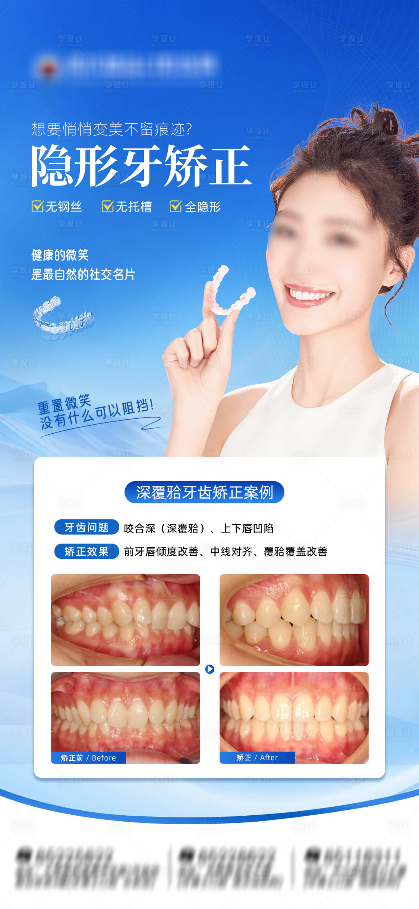 源文件下载【享设计】搜索编号：75160036737234641【口腔隐形矫正案例海报】