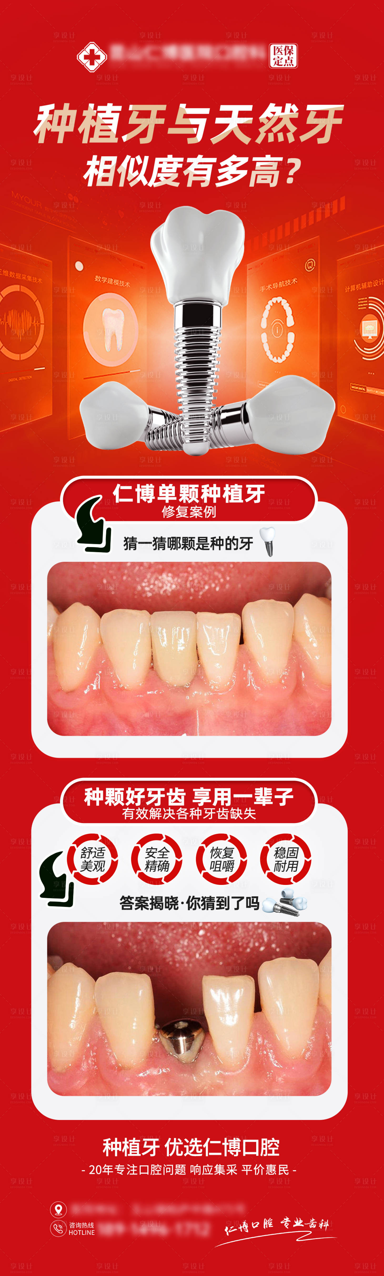 源文件下载【享设计】搜索编号：79160037495047960【口腔种植牙海报】